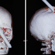Illustration for article titled Construction Worker Impaled Through the Brain Is a Modern-Day Phineas Gage
